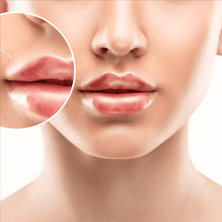 Lip Augmentation