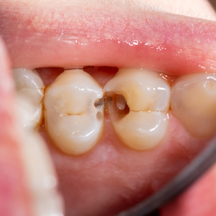 Broken Dental Filling